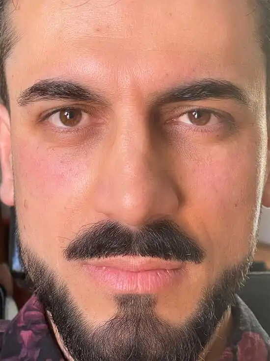 PRP-Before-After-1-B (1)