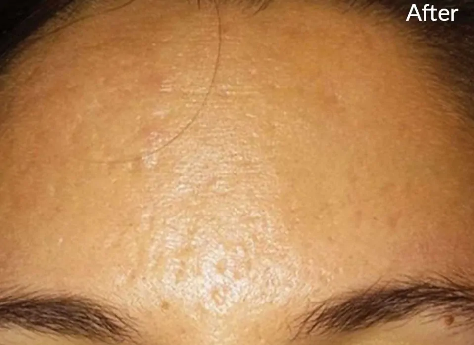 acne scars prp therapy after pic