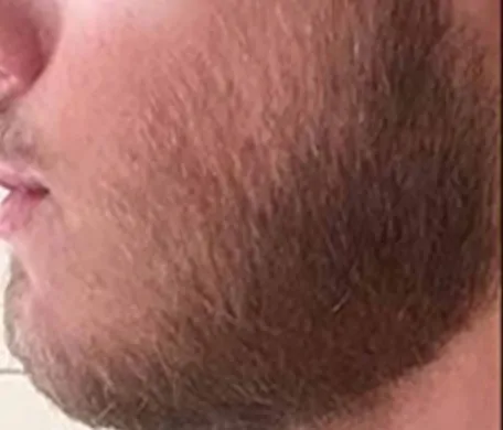 prp beard treatment before dublin