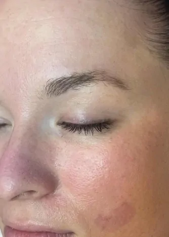 prp facial therapy after