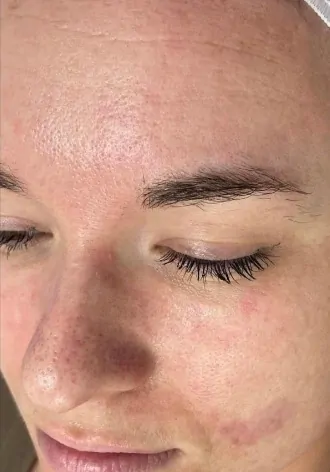 prp facial therapy before