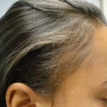 prp hair loss after treatment dublin