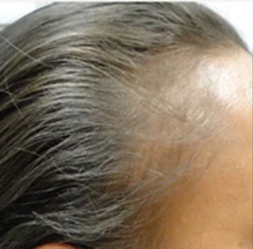 prp hair loss before treatment dublin