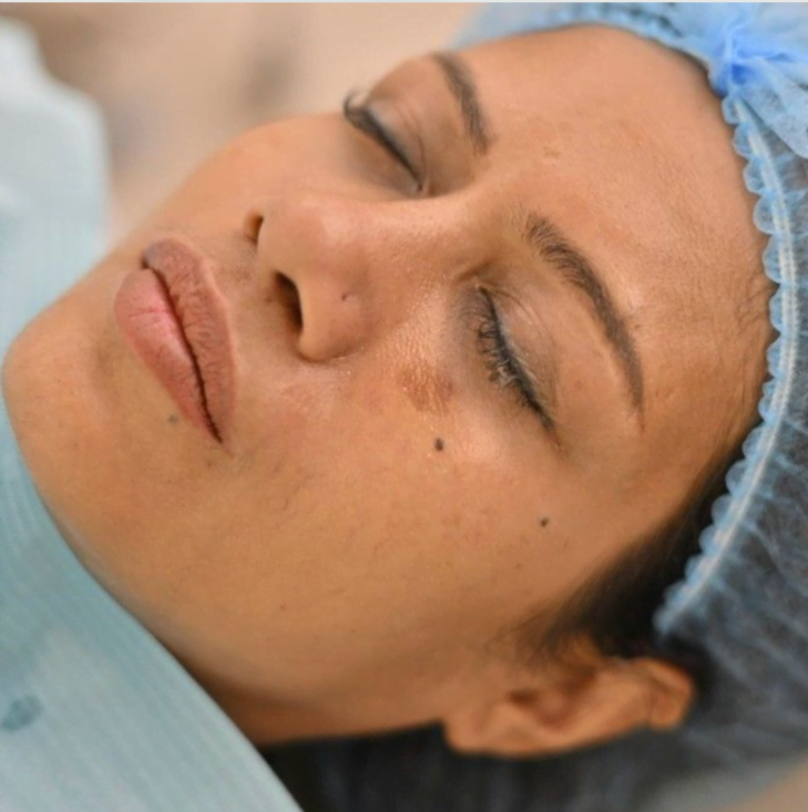 prp skin rejuvenation solutions before