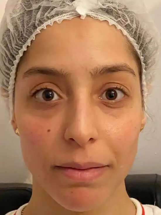 prp under eyes treatment before