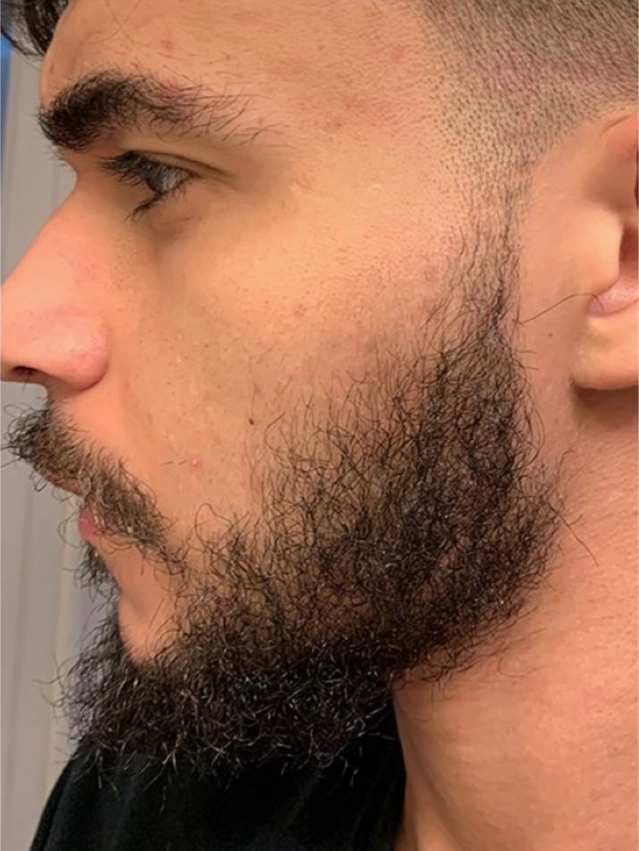 prp treatment to fix a patchy beard after