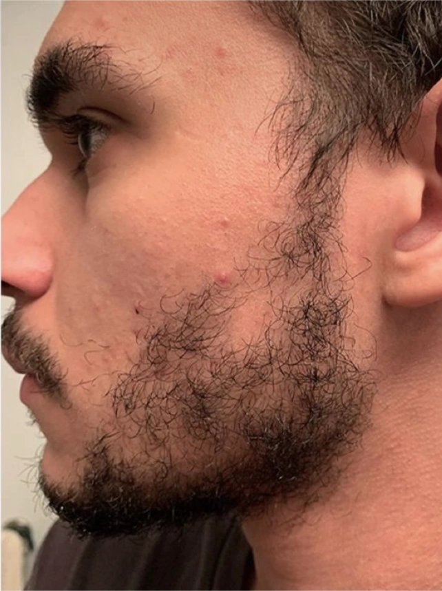 prp treatment to fix a patchy beard before