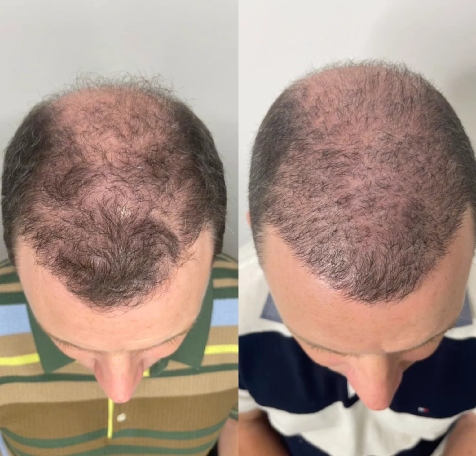 BEFORE AND AFTER PRP HAIR TREATMENT