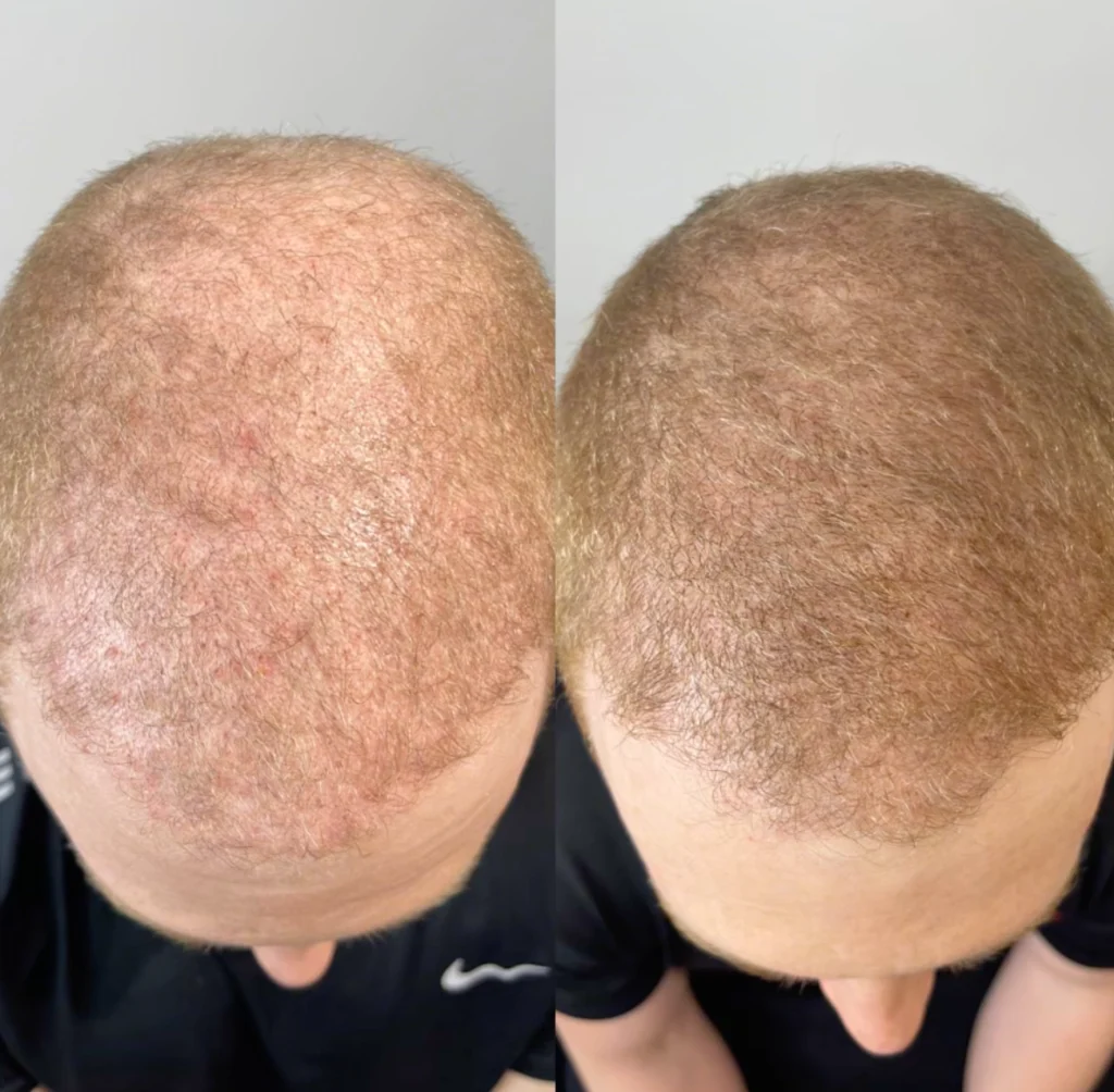 before and after hair transplant dublin