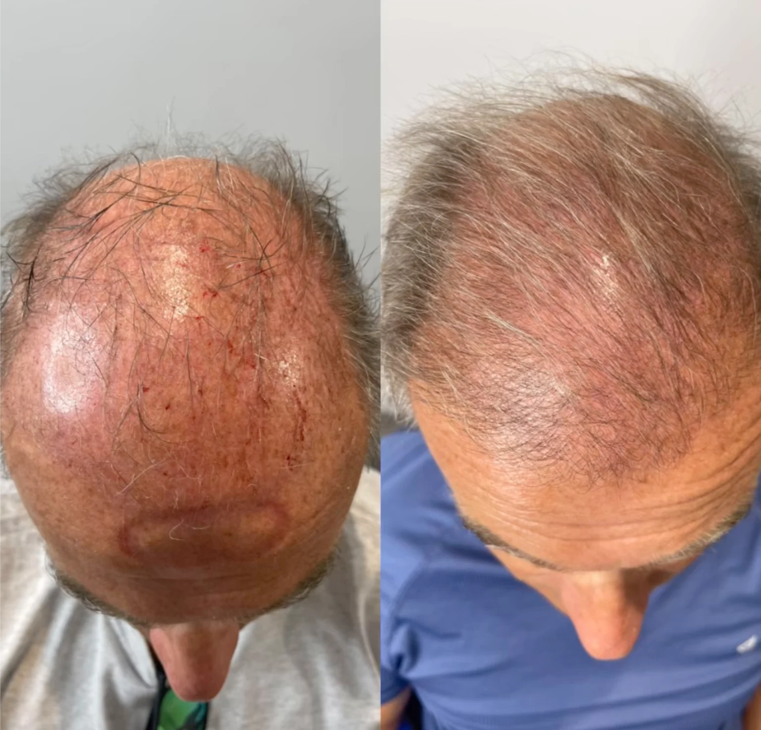 before and after hair transplant for men dublin