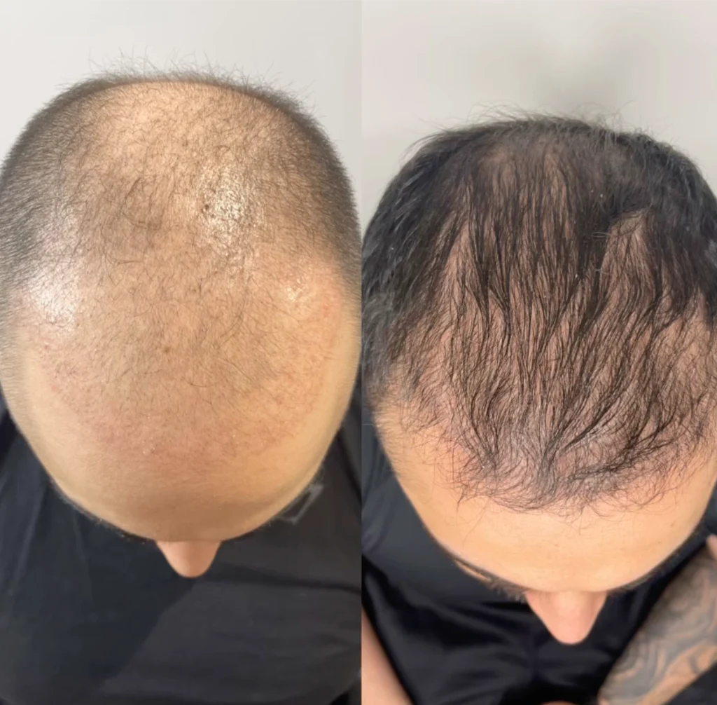 prp men hair growth